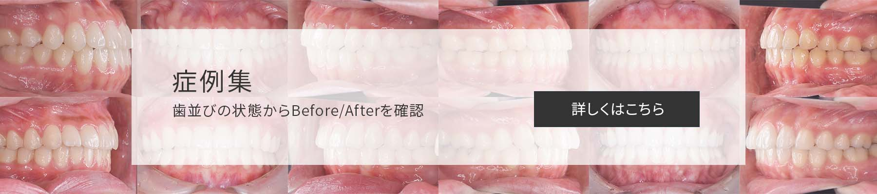 NICO矯正歯科の症例集